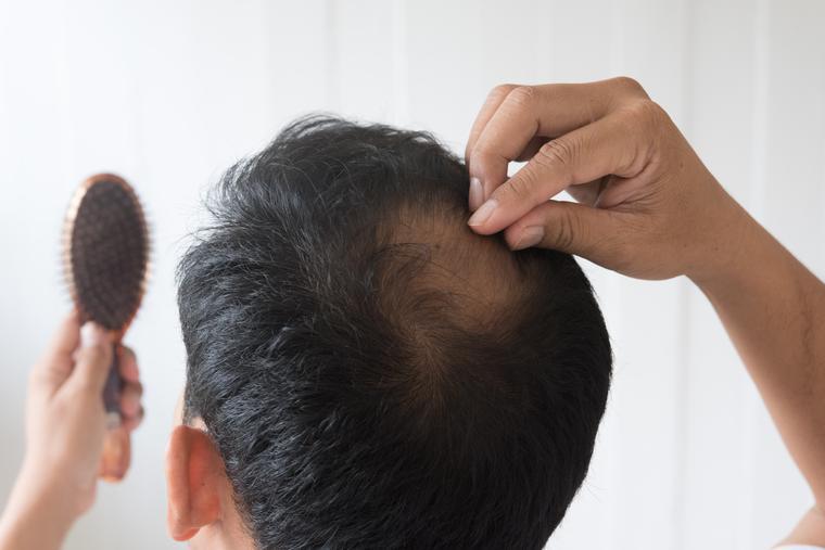 (P) Polvere per diradamento capelli, il prodotto che maschera istantaneamente la caduta dei capelli.