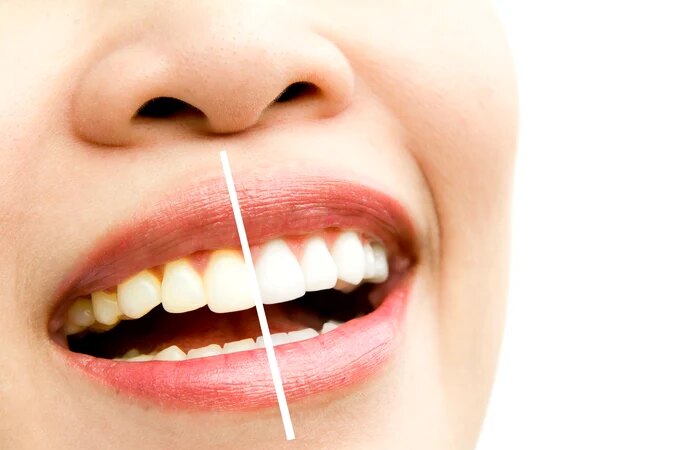 Sbiancamento dei denti in soli 2 minuti. Il metodo miracoloso contro tartaro e denti macchiati